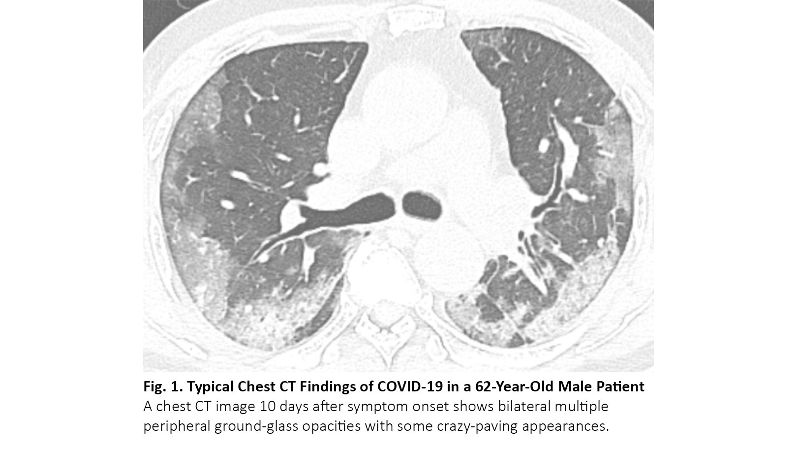 CT of COVID-19 Pneumonia and Mimicking Diseases Patients With Lung Cancer - ILCN.org (ILCN/WCLC)