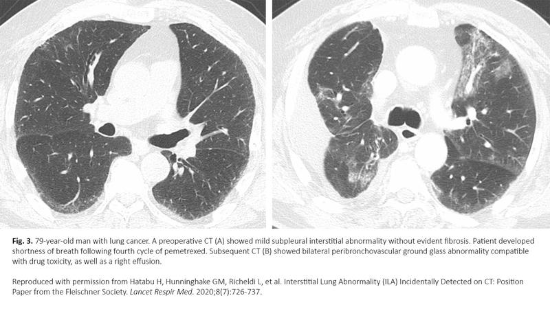 Interstitial Lung Abnormality, Interstitial Lung Disease, and Lung ...