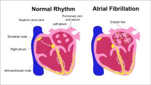 Arrhythmias after Radiotherapy—What Do (and Don’t) We Know? - ILCN.org ...